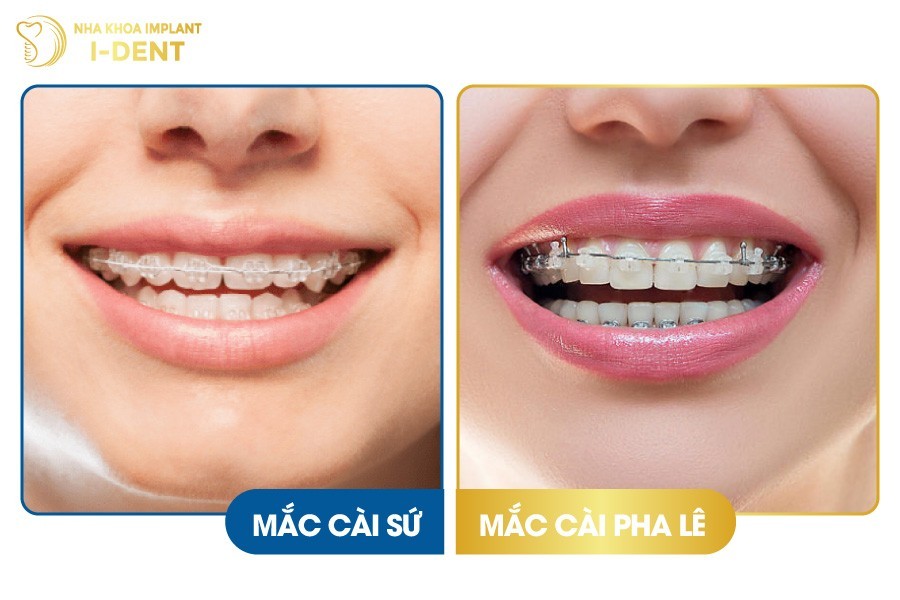 Niềng răng mắc cài sứ và niềng răng mắc cài pha lê
