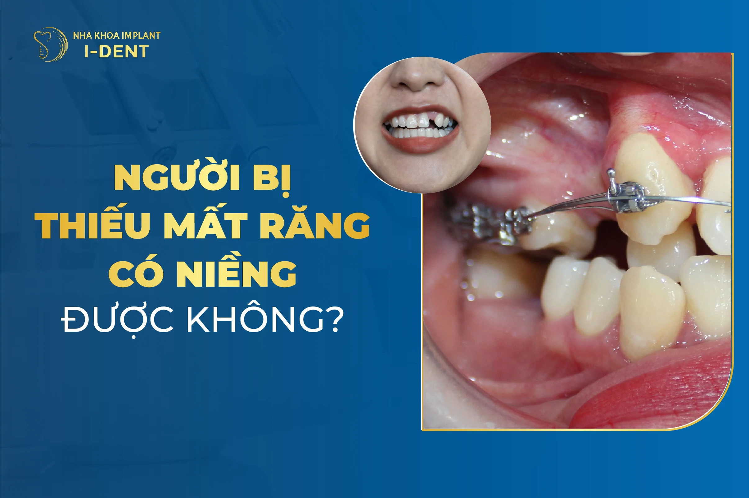 Nếu Bị Mất Răng Thì Có Niềng Được Không?