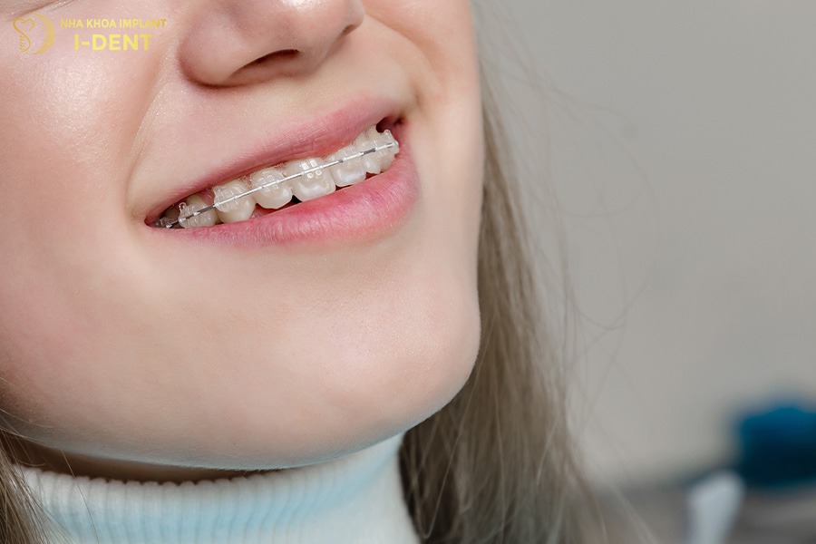 niềng răng mắc cài pha lê