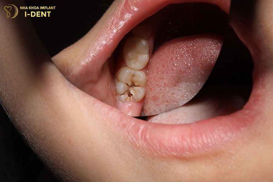 Bị sâu răng nên phải nhổ làm mất răng