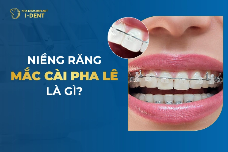 Niềng Răng Mắc Cài Pha Lê Là Gì? Ưu Nhược Điểm Mắc Cài Pha Lê