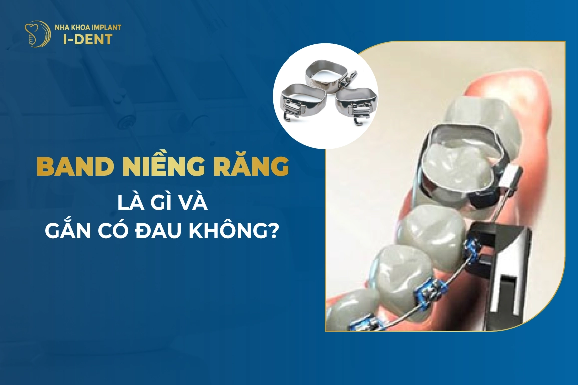 Band Niềng Răng Là Gì? Và Gắn Có Đau Không?