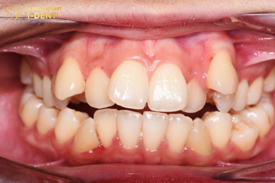 cắm vít khi niềng răng