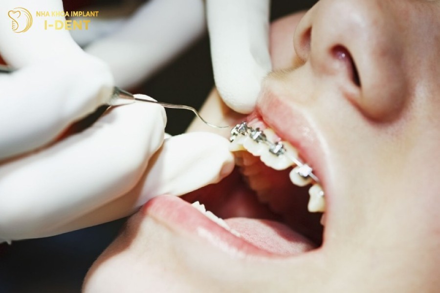 Benh-nhan-can-tuan-thu-lich-tai-kham-de-dam-bao-ket-qua-nieng-rang-thanh-cong