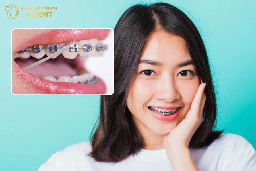 Đeo thun niềng răng giúp điều chỉnh răng lệch lạc một cách nhanh chóng