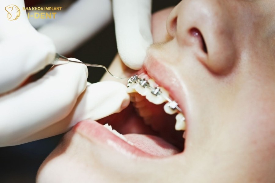 Gan-Band-nieng-rang-nhe-nhang-tai-nha-khoa-I-DENT