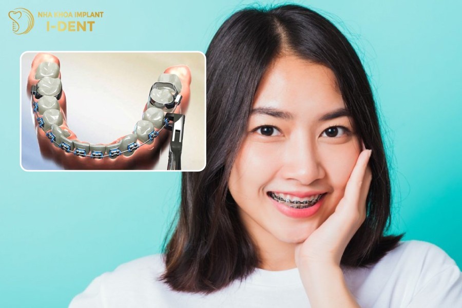 Gan-band-nieng-rang-giup-rut-ngan-thoi-gian-nieng-rang