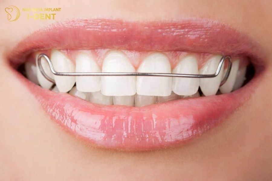 Ham-duy-tri-giu-cho-rang-on-dinh-khong-bi-chay-sau-khi-thao-nieng