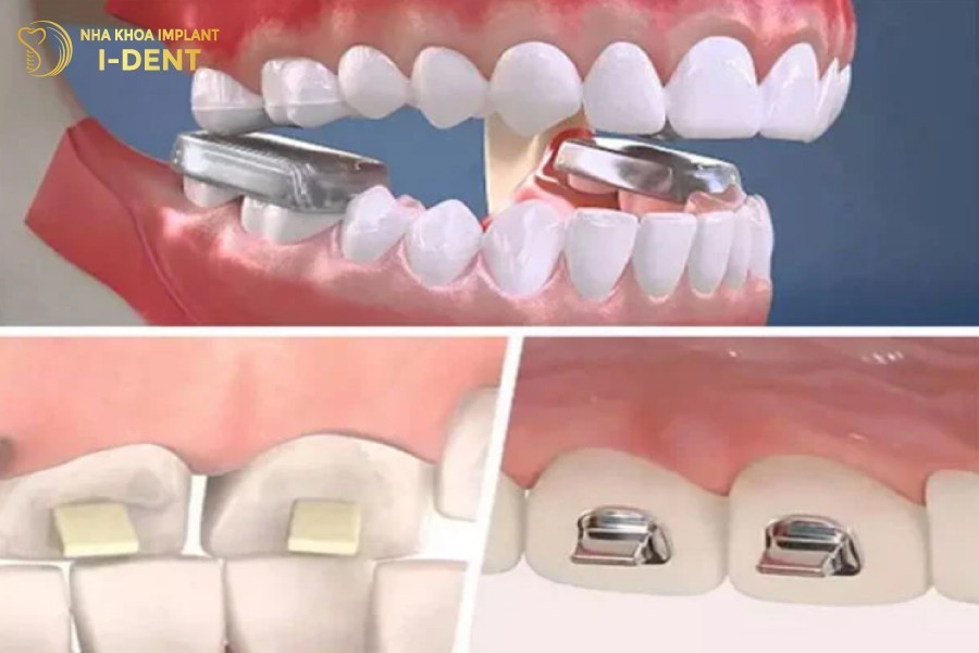 nâng hàm khi niềng răng