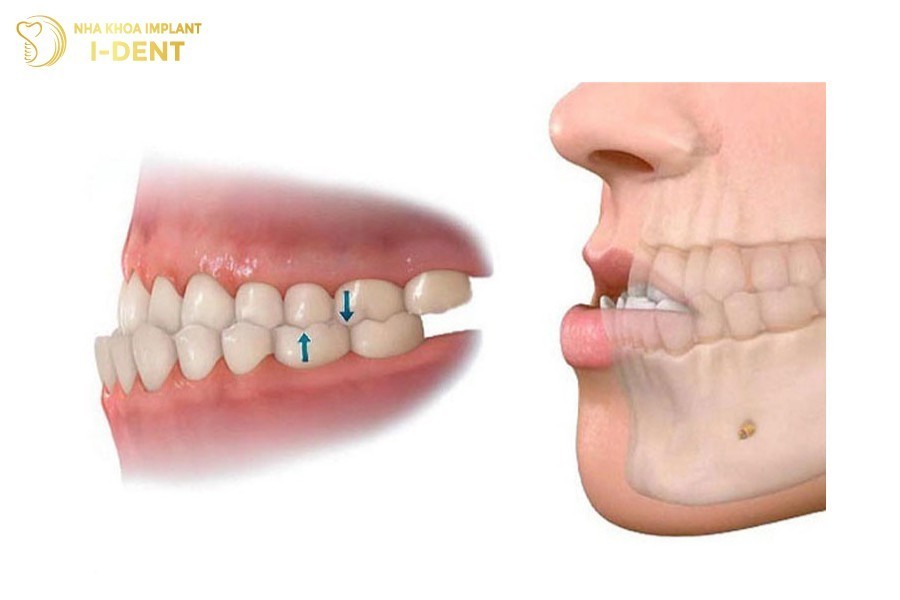 nâng khớp cắn trong niềng răng