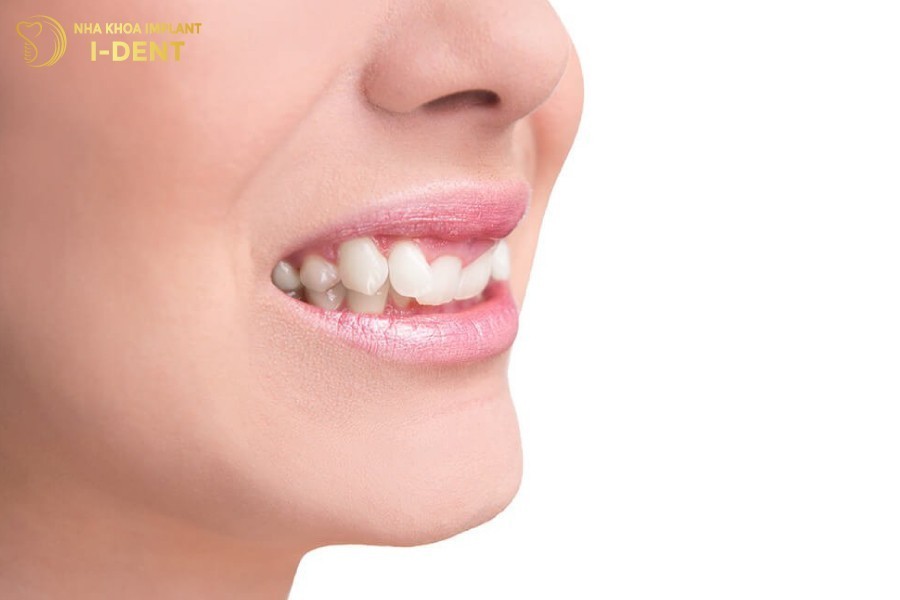 nâng khớp cắn niềng răng