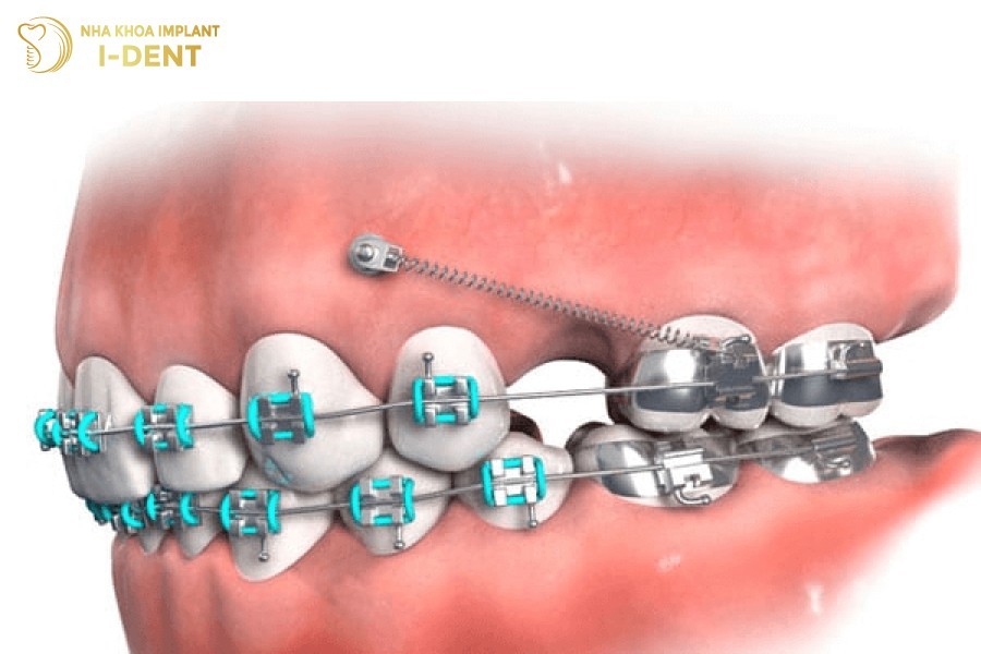 Lap-band-nieng-rang-suot-qua-trinh-nieng-rang