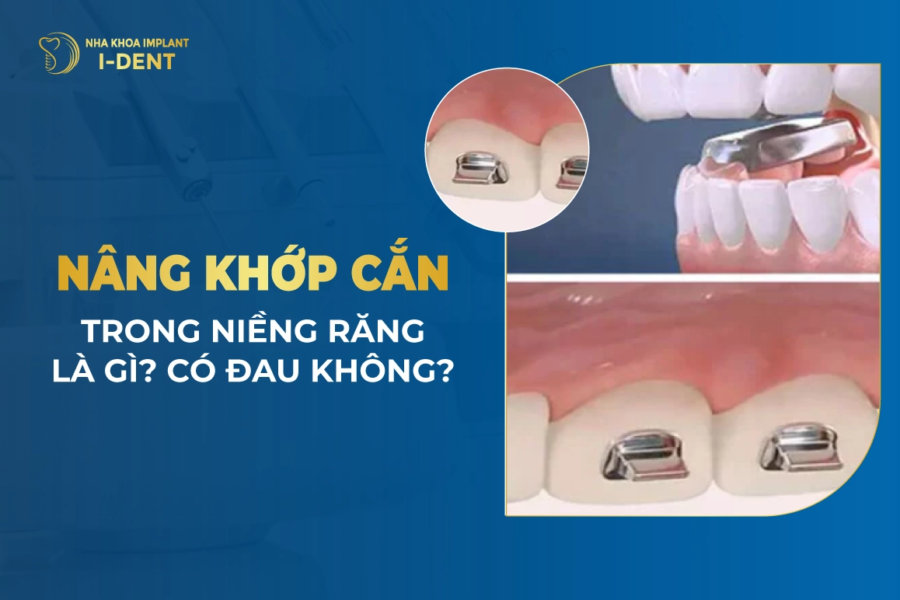 nâng khớp niềng răng