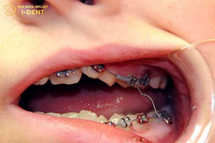 Neu-phai-dieu-tri-cac-benh-ly-rang-mieng-se-keo-dai-thoi-gian-nieng-rang