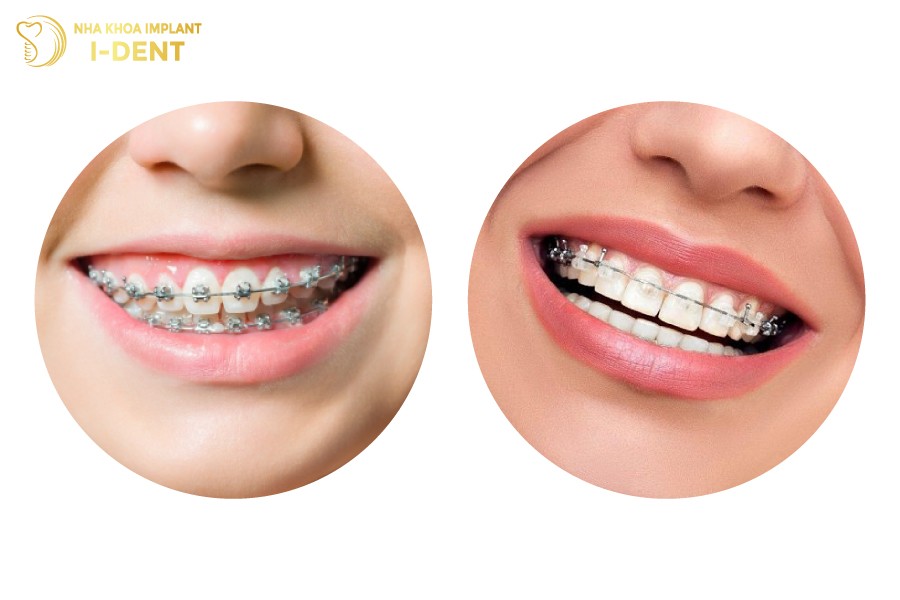 Nieng-rang-mac-cai-kim-loai-va-mac-cai-su-tu-buoc