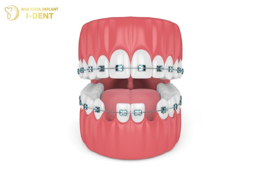 Nieng-rang-mac-cai-kim-loai.
