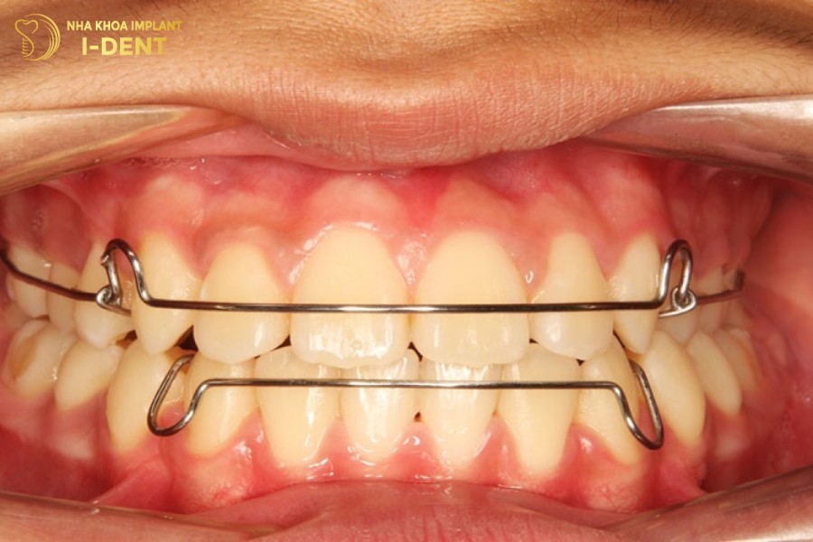 O-giai-doan-cuoi-cac-khi-cu-nieng-se-giu-cho-rang-on-dinh-o-vi-tri-moi