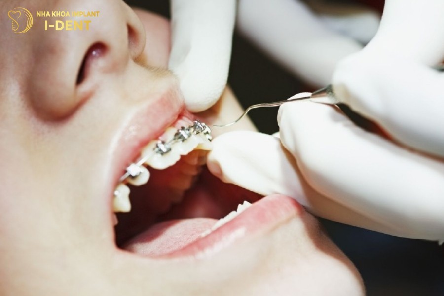 Siet-rang-dinh-ky-la-nhung-thoi-diem-ma-benh-nhan-cam-nhan-duoc-con-dau-ro-ret.