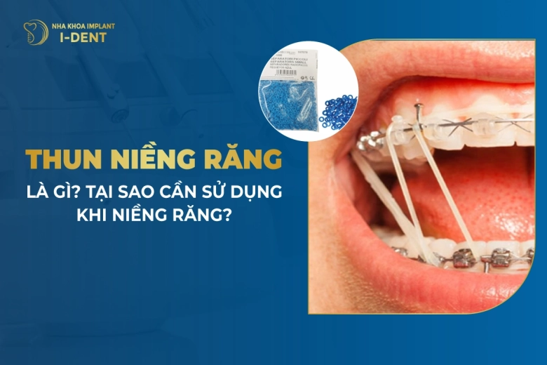 Dây Thun Niềng Răng Là Gì? Cách Đeo Thun Liên Hàm