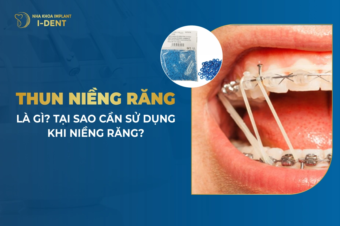 Dây Thun Niềng Răng Là Gì? Cách Đeo Thun Liên Hàm