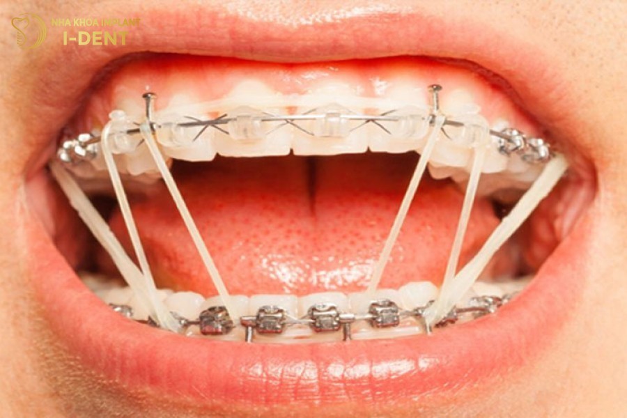 Thun niềng răng giúp tạo sự liên kết giữa dây cung và mắc cài