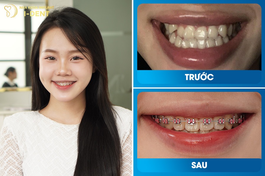 Từ hàm răng khấp khểnh thiếu tự tin, sau niềng răng trở nên ngay ngắn, nụ cười rạng rỡ.