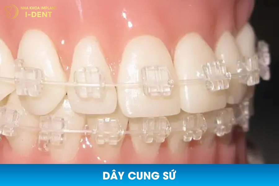 Dây cung niềng sứ