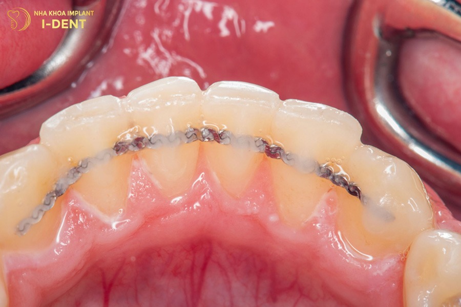 Hàm duy trì cố định gắn ở mặt trong của răng