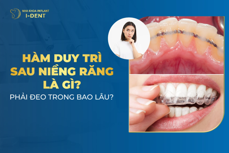 Hàm duy trì sau niềng răng có mấy loại? Đeo trong bao lâu?