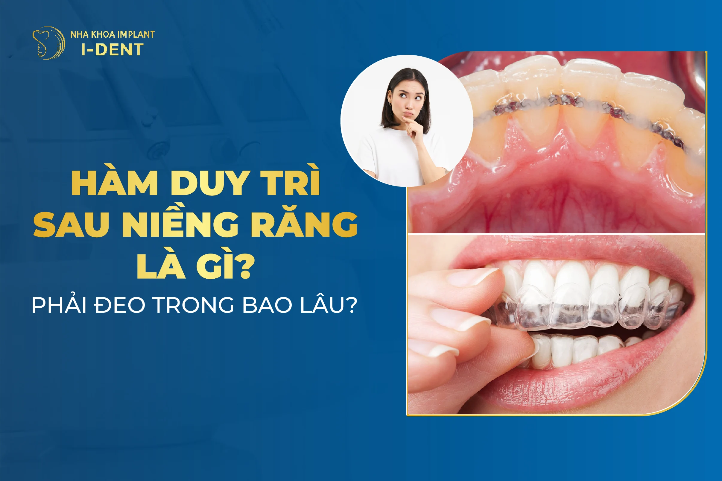Hàm duy trì sau niềng răng có mấy loại? Đeo trong bao lâu?