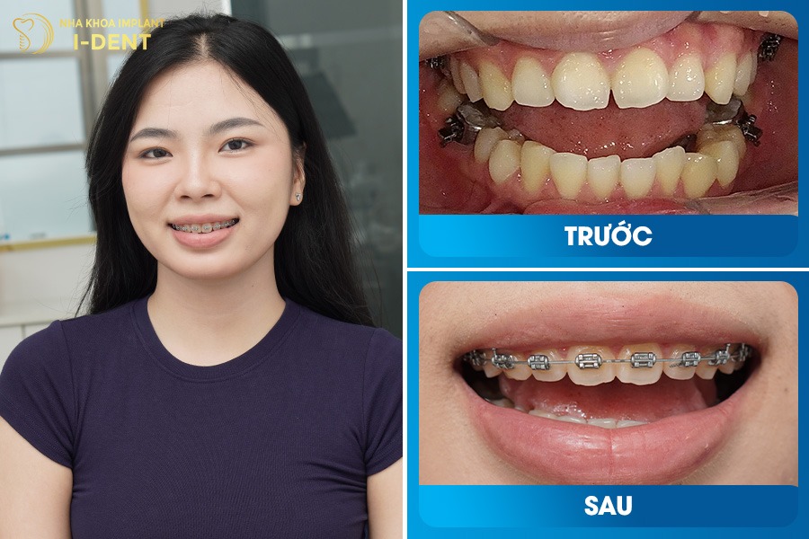 Niềng răng ở độ tuổi thanh thiếu niên cải thiện rõ rệt khuôn mặt và nụ cười tự nhiên.