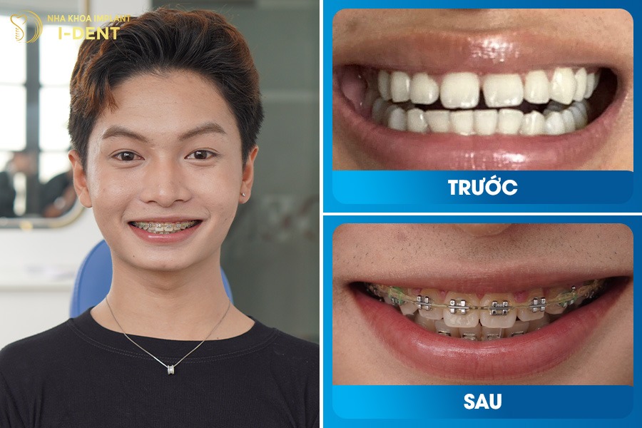 Niềng răng hô giúp gương mặt thanh thoát và nụ cười rạng rỡ hơn.