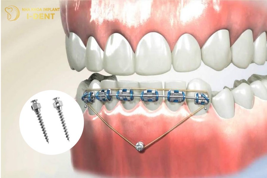 bắt vít niềng răng là gì