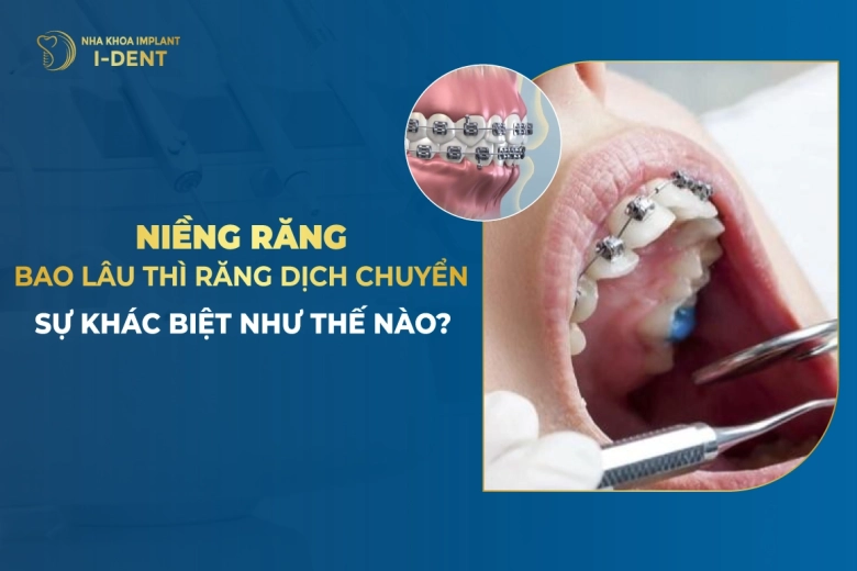 Niềng Răng Bao Lâu Thì Răng Dịch Chuyển? Sự Khác Biệt Như Thế Nào?