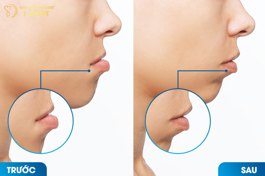 Niềng răng giúp khép môi tự nhiên, khắc phục tình trạng môi nhô ra.