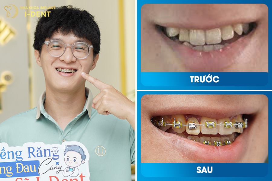 Trước khi niềng, hàm dưới đưa ra ngoài - Sau niềng, khớp cắn chuẩn và gương mặt cân đối hơn.