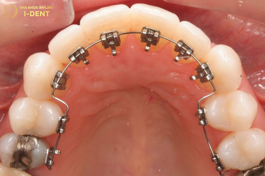 các bước niềng răng mắc cài kim loại