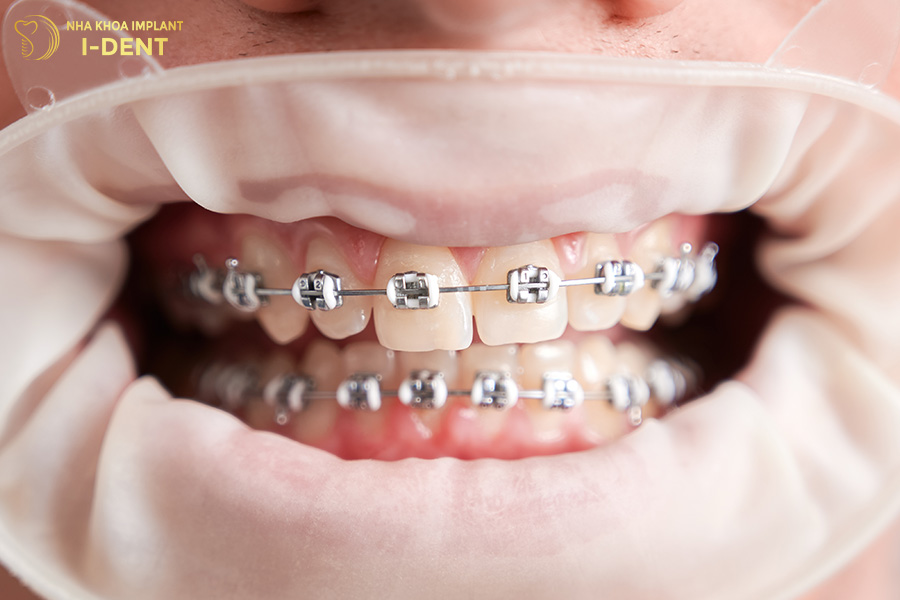 quy trình niềng răng mắc cài kim loại