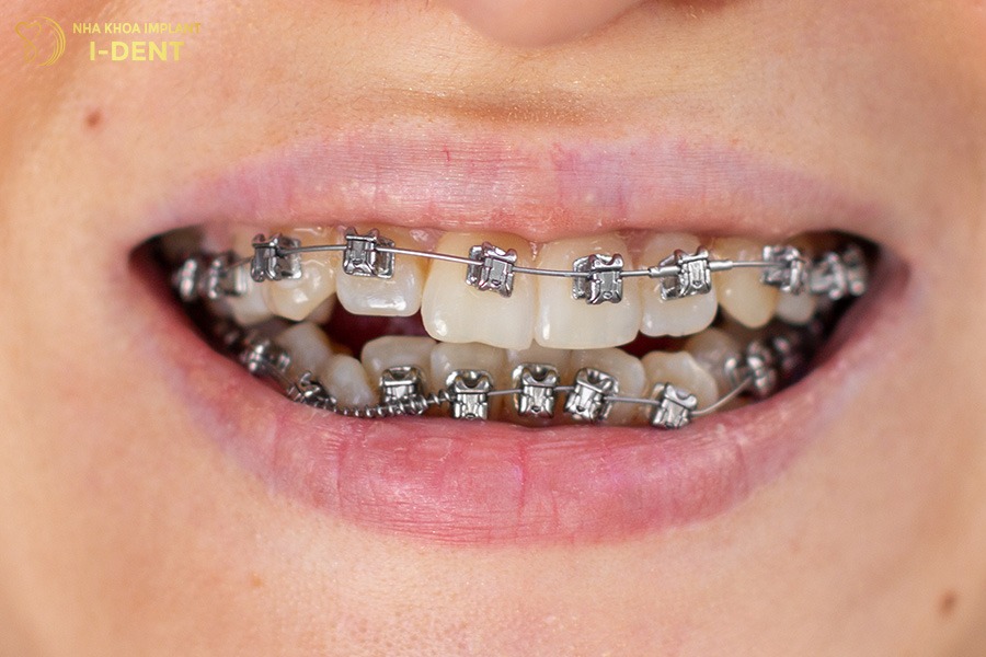 niềng răng kim loại