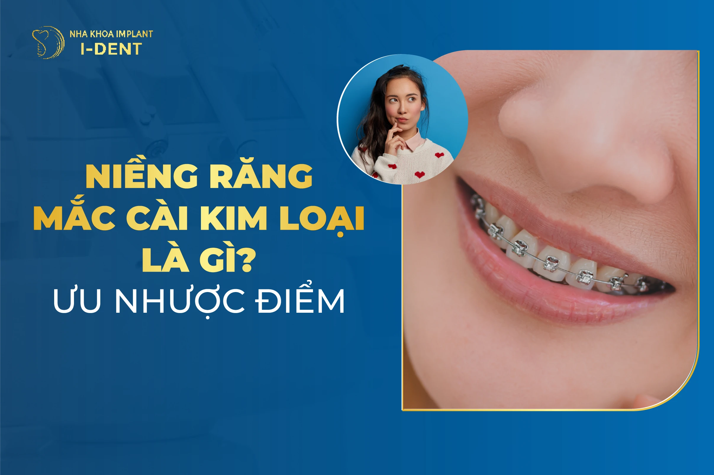 Niềng răng mắc cài kim loại là gì? Chi phí, ưu điểm, quy trình