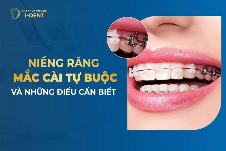 Niềng răng mắc cài tự buộc (tự đóng) là gì? Giá bao nhiêu?