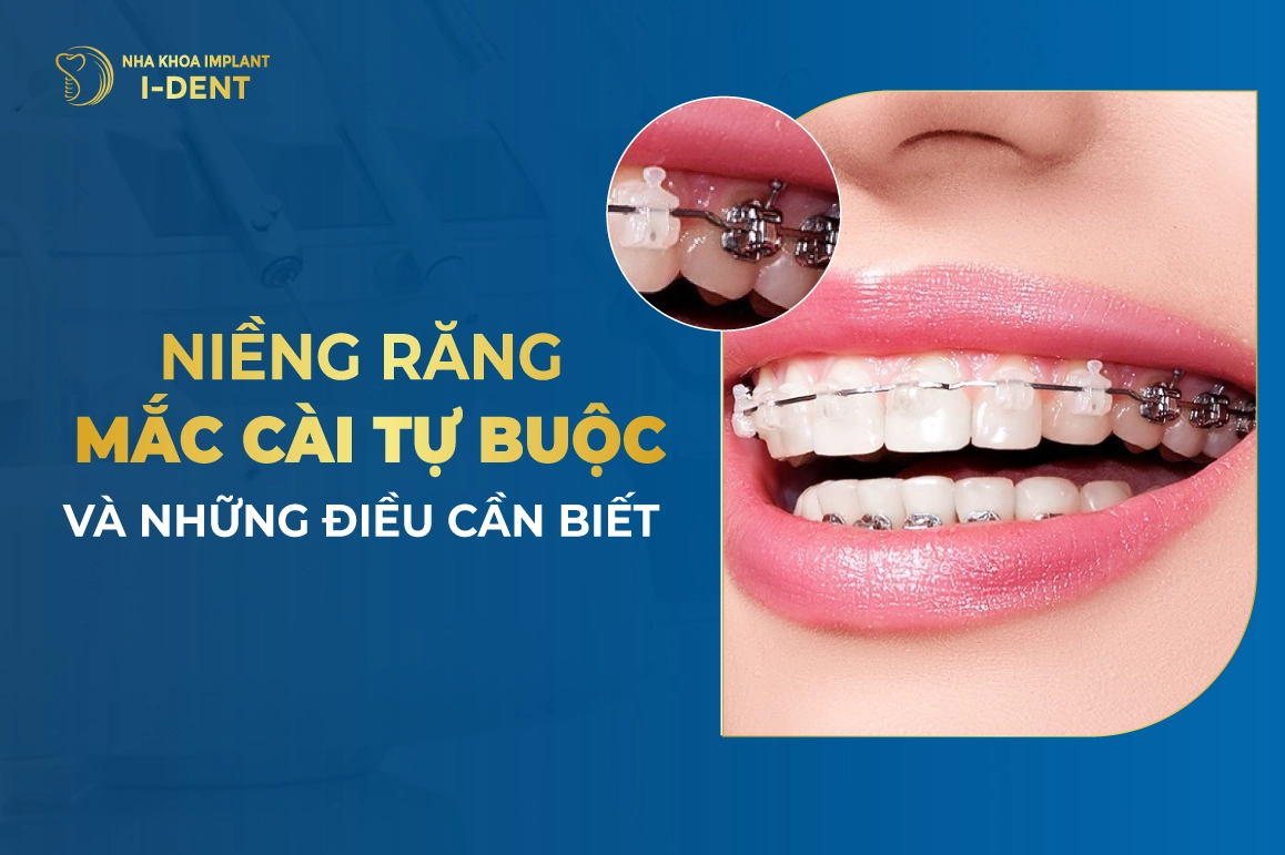 Niềng răng mắc cài tự buộc (tự đóng) là gì? Giá bao nhiêu?