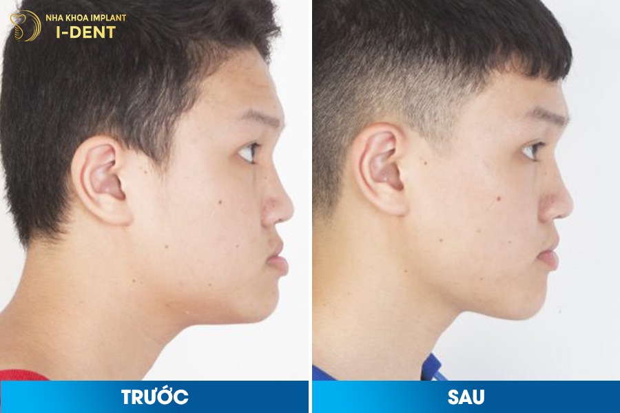 Niềng răng móm giúp đưa hàm dưới lùi vào, cải thiện đáng kể đường nét gương mặt.