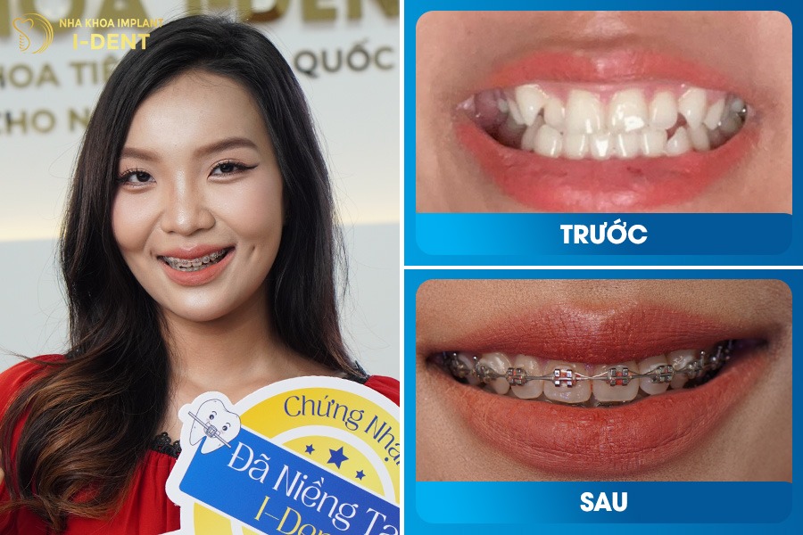 Răng đều và sát khít giúp nụ cười tự tin, hài hòa hơn.