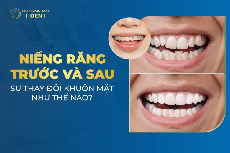 Trước Và Sau Khi Niềng Răng Có Làm Thay Đổi Khuôn Mặt