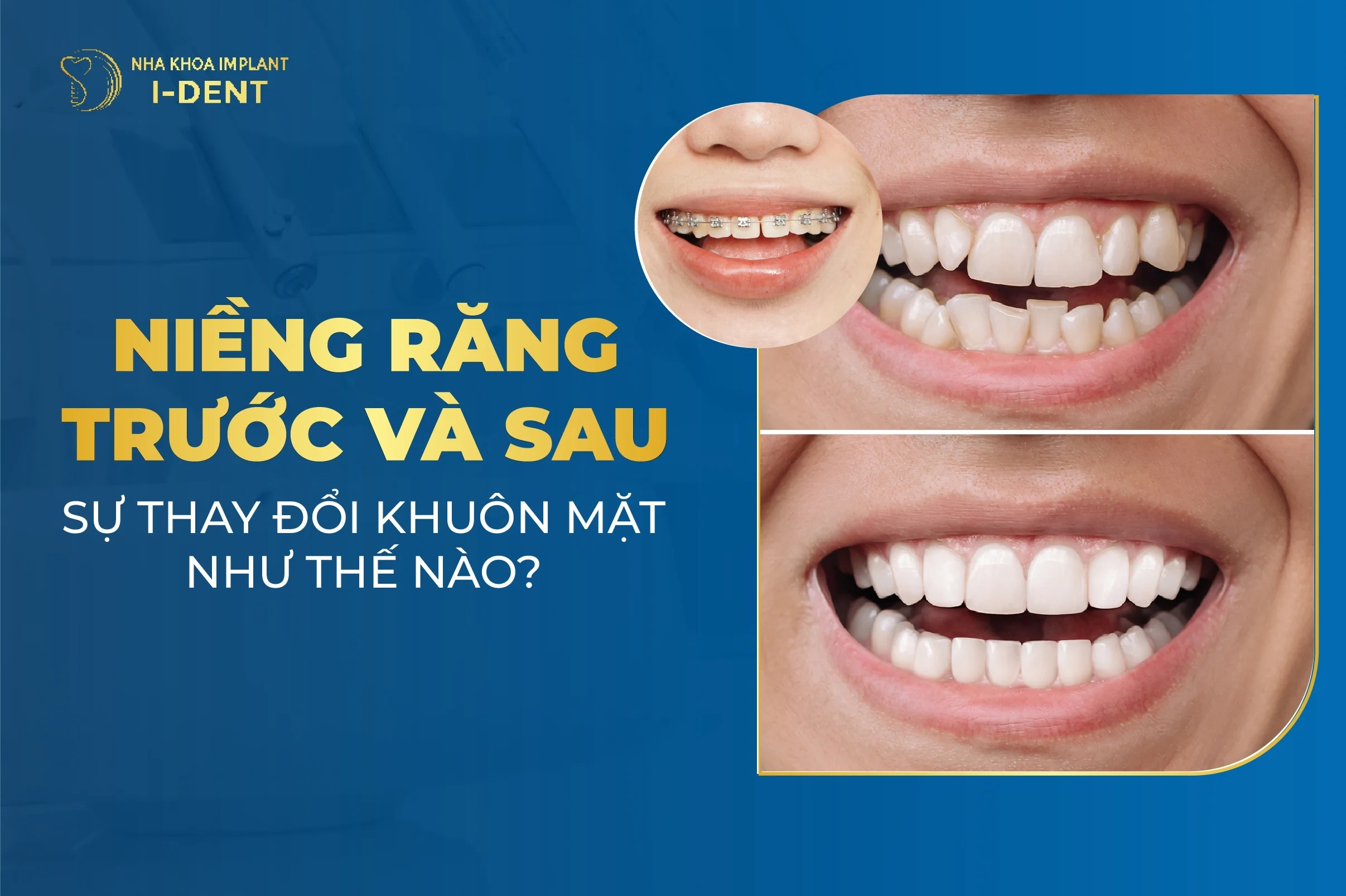Trước Và Sau Khi Niềng Răng Có Làm Thay Đổi Khuôn Mặt