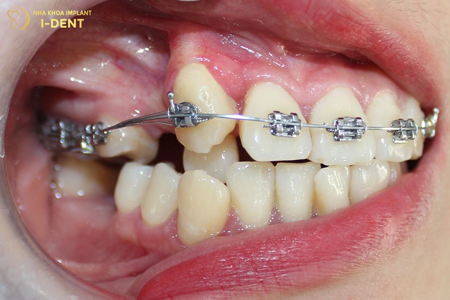 Ở mỗi giai đoạn chỉnh nha dây cung sẽ có công dụng khác nhau