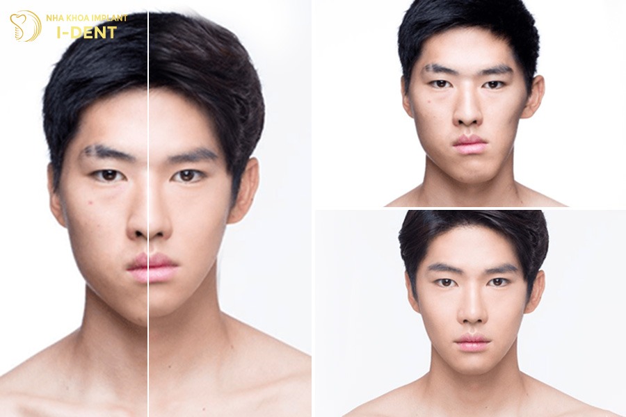 Mức độ thay đổi khuôn mặt khi niềng răng sẽ khác nhau ở mỗi người