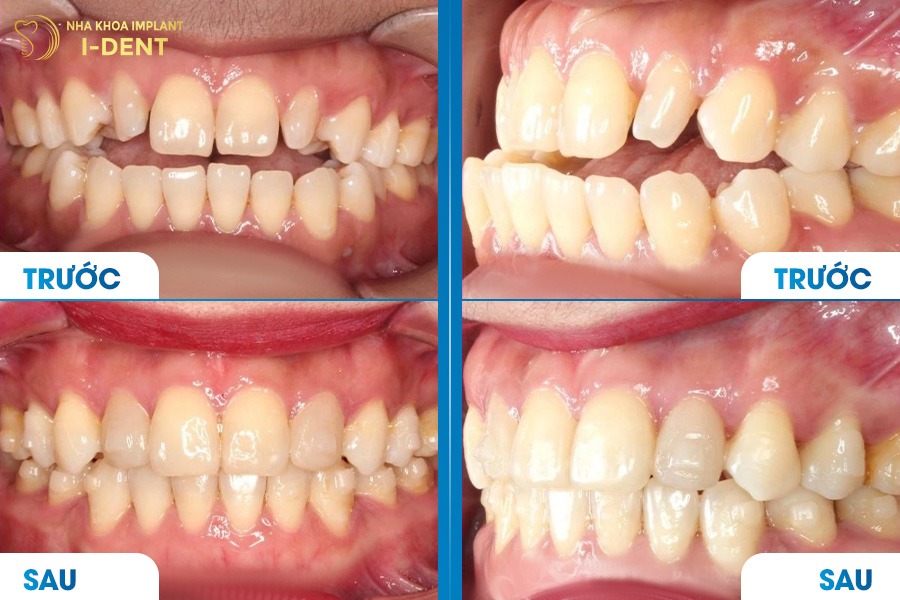 Răng đều, lợi khỏe hơn nhờ quá trình chỉnh nha đúng kỹ thuật.
