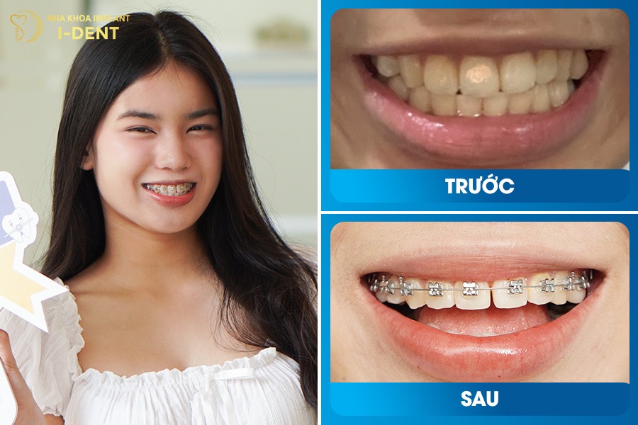 Niềng răng hô giúp khuôn miệng khép tự nhiên, cải thiện nụ cười.